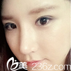 做的切開雙眼皮，恢復到30天的時候就近乎自然