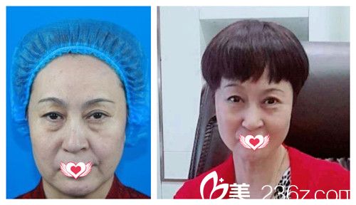 天伊美整形醫(yī)院做埋線提升案例 天伊美整形醫(yī)院做埋線提升案例