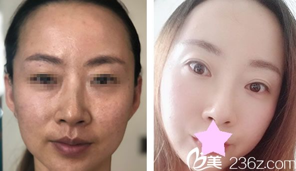 趙宏遠面部線雕提升效果對比圖