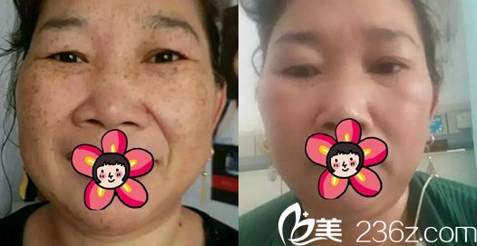 義烏連天美皮秒激光祛斑<span style=