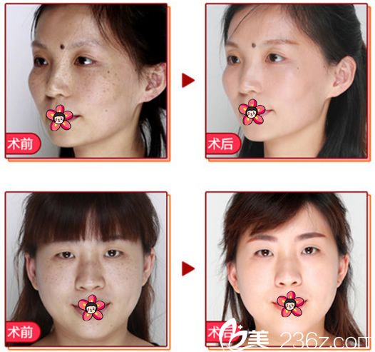 義烏連天美激光祛斑<span style=