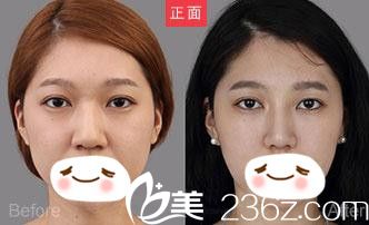 信陽易韓安和美容整形醫(yī)院隆鼻手術效果圖 信陽易韓安和美容整形醫(yī)院隆鼻手術效果圖