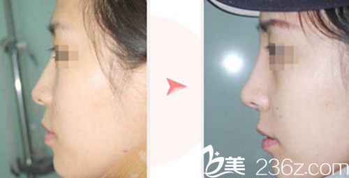 CELLA整形醫(yī)院隆鼻案例 CELLA整形醫(yī)院隆鼻案例