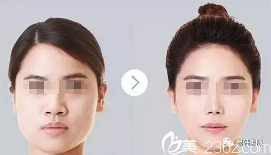 張院長所做的心形臉自體脂肪填充整形案例 張院長所做的心形臉自體脂肪填充整形案例