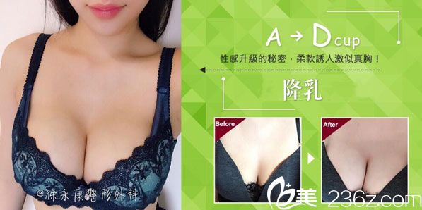 徐永康醫(yī)師隆胸案例