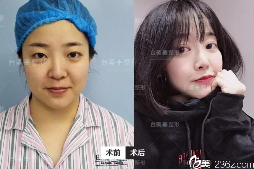 合肥哪家整形醫(yī)院做眼綜合好？合肥臺(tái)美麗格整形用眼綜合真實(shí)案例來(lái)說(shuō)話