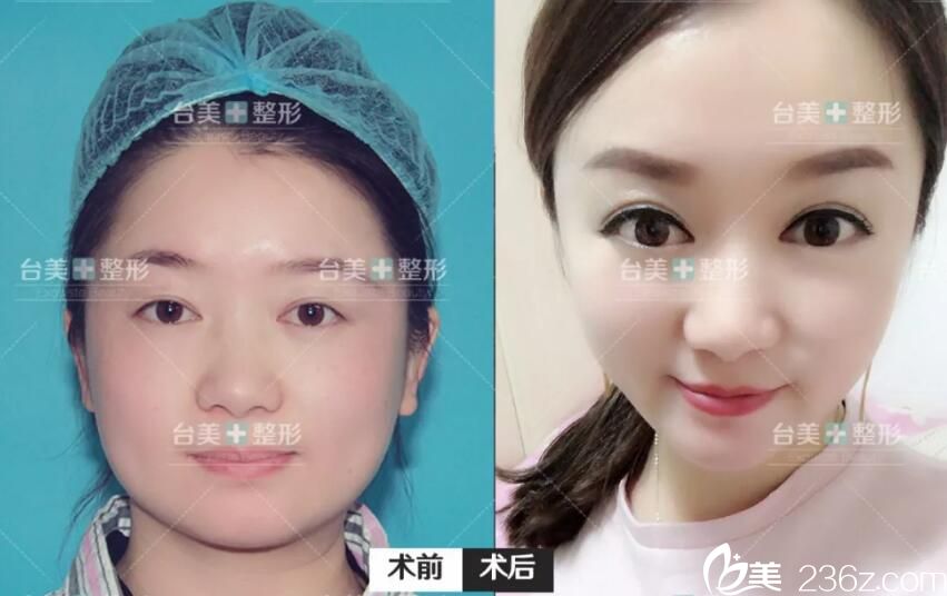 葉凡眼綜合整形案例前后效果對(duì)比圖