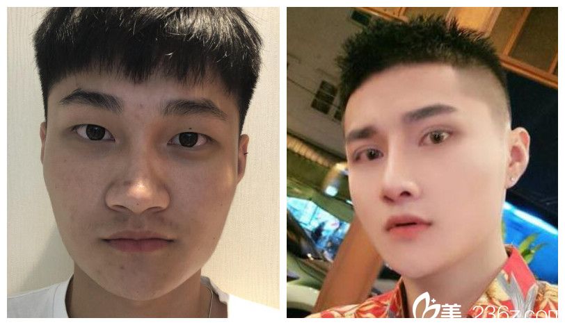 臺(tái)美麗格整形穆威眼綜合+鼻綜合整形案例