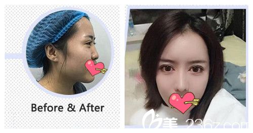 沈陽元辰陳軍割雙眼皮案例 沈陽元辰陳軍割雙眼皮案例