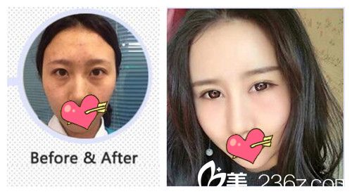 沈陽元辰譚臻田隆鼻對比圖 沈陽元辰譚臻田隆鼻對比圖