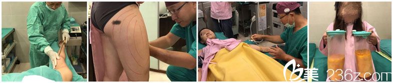 徐永康醫(yī)生為我設(shè)計吸脂方案