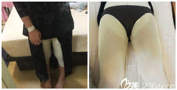 吸脂后穿著塑身衣