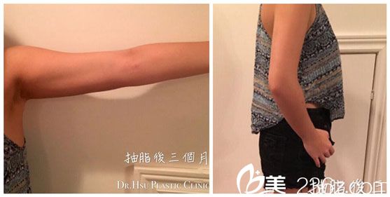 徐永康醫(yī)生做三合一吸脂術(shù)后恢復(fù)三個月