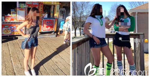 麒麟臂、粗壯腿找中國(guó)臺(tái)灣徐永康醫(yī)師做三合一抽脂術(shù)吸出3800cc恢復(fù)后告別吃酵素