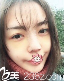 尹賢哲院長給我手術后第三天