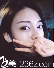 尹賢哲假體隆鼻術后一個月