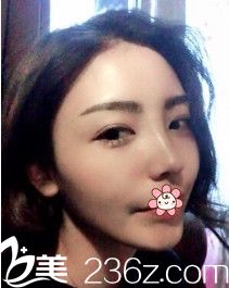 韓國nplus整形外科隆鼻技術怎么樣