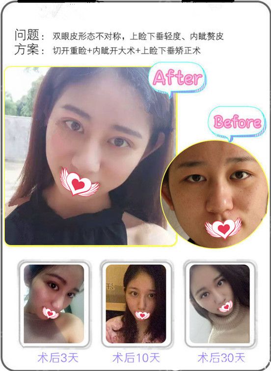 東莞美立方張克雙眼皮恢復(fù)效果圖