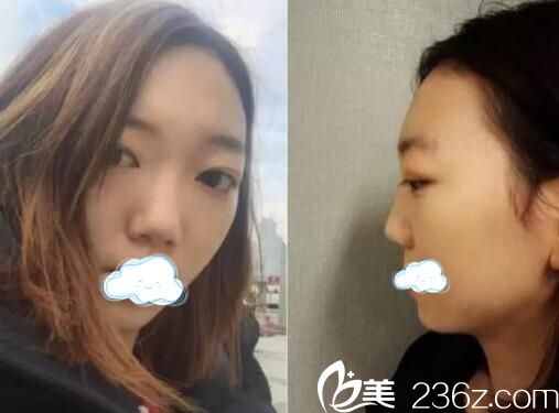 鼻綜合手術前正面?zhèn)让嬲掌? alt=