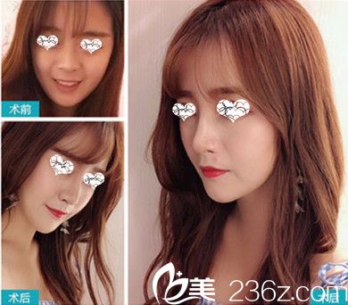 東莞美立方整形醫(yī)院隆鼻前后對比圖