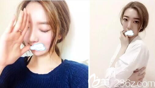 <!--<i data=20240703-sp></i>-->悅美鼻綜合4個月恢復效果圖 <!--<i data=20240703-sp></i>-->悅美鼻綜合4個月恢復效果圖