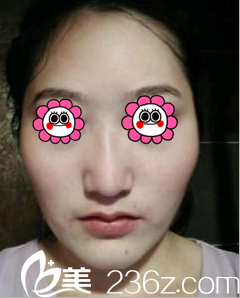 在北京聯(lián)合麗格做顴骨顴弓整形術前樣子 在北京聯(lián)合麗格做顴骨顴弓整形術前樣子