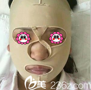 醫(yī)生給我做顴骨顴弓整形術后當天樣子 醫(yī)生給我做顴骨顴弓整形術后當天樣子