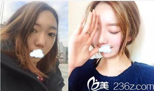 做過(guò)隆鼻的朋友看了我在華美悅美做的鼻綜合手術(shù)效果竟然想去做修復(fù)