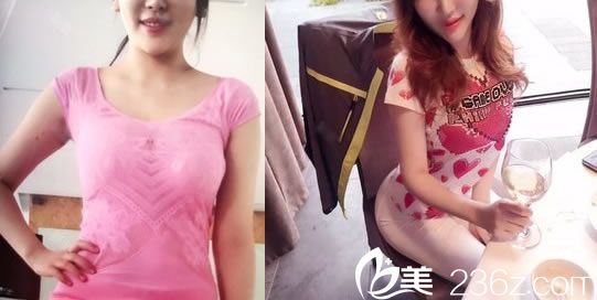 在嘉興曙光醫(yī)院做隆胸手術(shù)前 在嘉興曙光醫(yī)院做隆胸手術(shù)前