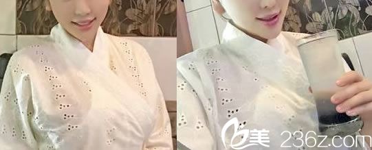 做完假體隆胸7天拆線效果圖 做完假體隆胸7天拆線效果圖