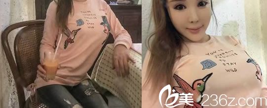 看嘉興曙光都成立15年了而且口碑評價不錯,就放心的找高俊院長做了假體和自體脂肪復(fù)合隆胸