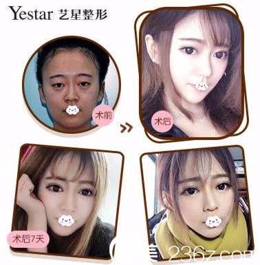 武漢藝星雙眼皮案例效果對比圖 武漢藝星雙眼皮案例效果對比圖