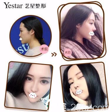 武漢Yestar藝星楊國梁假體鼻綜合案例對比效果 武漢Yestar藝星楊國梁假體鼻綜合案例對比效果
