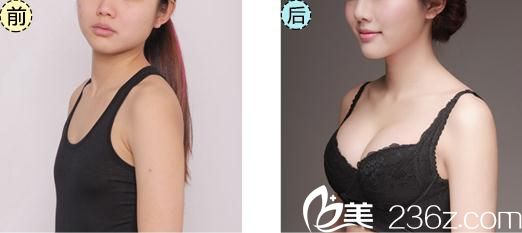武漢藝星徐國建假體隆胸案例前后對比圖 武漢藝星徐國建假體隆胸案例前后對比圖