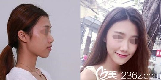 深圳鵬程整形醫(yī)院假體隆鼻案例圖