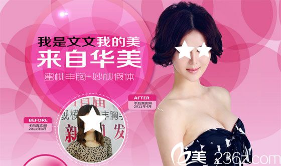 柳州華美整形假體隆胸術(shù)前術(shù)后對(duì)比圖