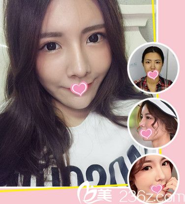 藍山整形醫(yī)院隆鼻案例