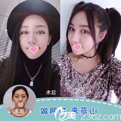 石家莊藍山脂肪填充面部案例