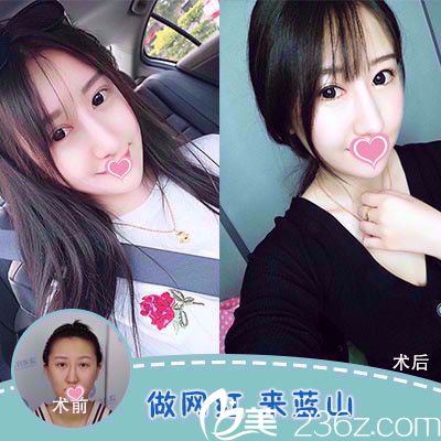 藍山整形醫(yī)院做雙眼皮案例