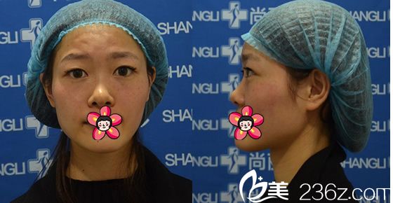 找湖州尚麗胡承林做雙眼皮和隆鼻前 找湖州尚麗胡承林做雙眼皮和隆鼻前