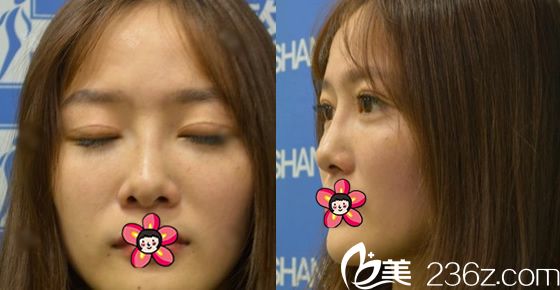 做完雙眼皮和隆鼻15天恢復照 做完雙眼皮和隆鼻15天恢復照