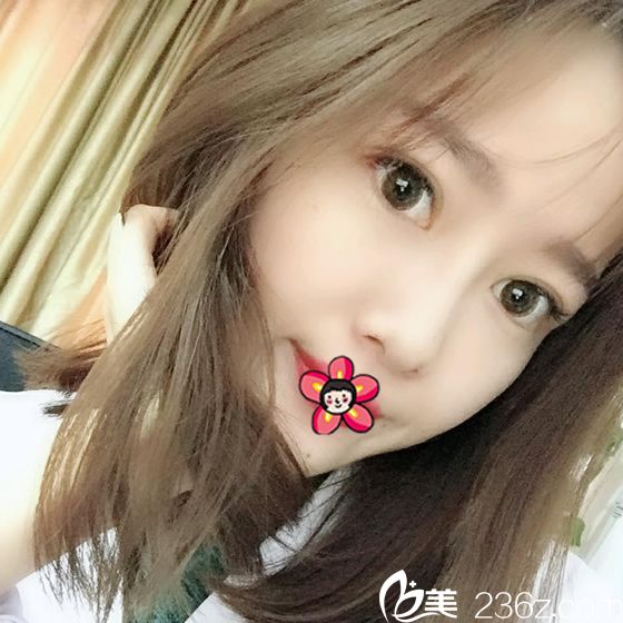 給你們看看我找湖州尚麗整形譚成林院長割雙眼皮和做隆鼻40天拍的高清寫真照