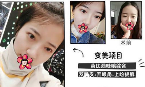 湖州尚麗芭比翹睫眼綜合案例 湖州尚麗芭比翹睫眼綜合案例