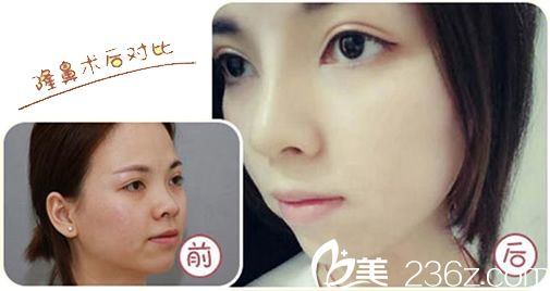 湖州尚麗假體隆鼻真人案例 湖州尚麗假體隆鼻真人案例