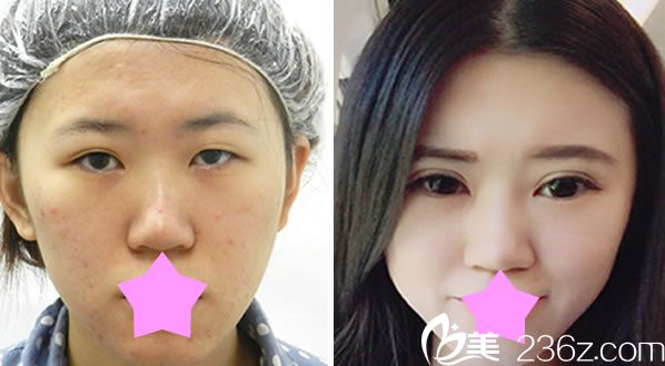 張世幸做眼綜合+全切雙眼皮對(duì)比圖