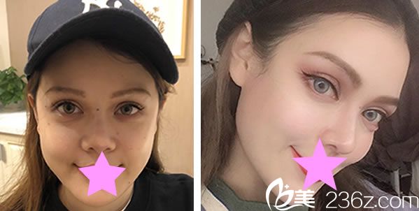 陳大正耳軟骨隆鼻對(duì)比圖