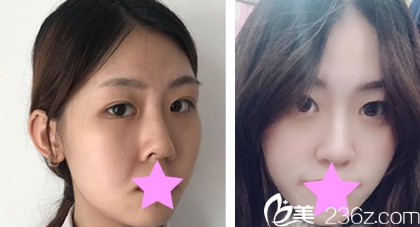 韓風(fēng)時(shí)尚整形醫(yī)院陳怡傑院長(zhǎng)面部線雕提升對(duì)比圖