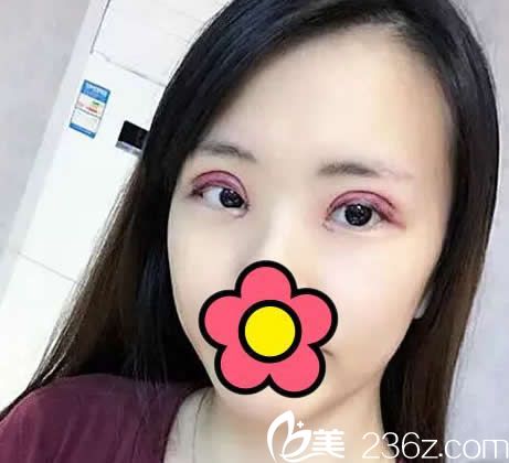 全切雙眼皮第二天