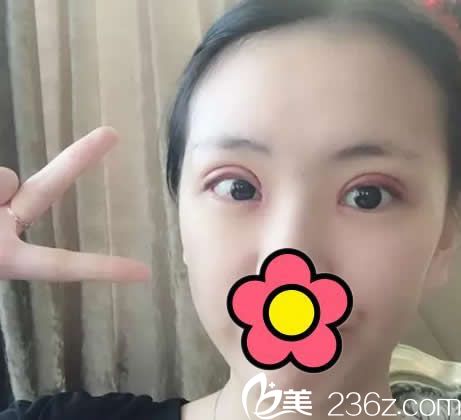 割雙眼皮開眼角第四天效果