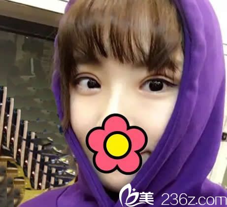 <!--<i data=20240703-sp></i>-->整形切開雙眼皮半個月